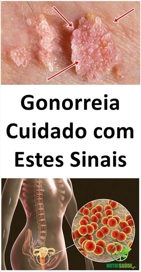 gonorreias feminina sintomas